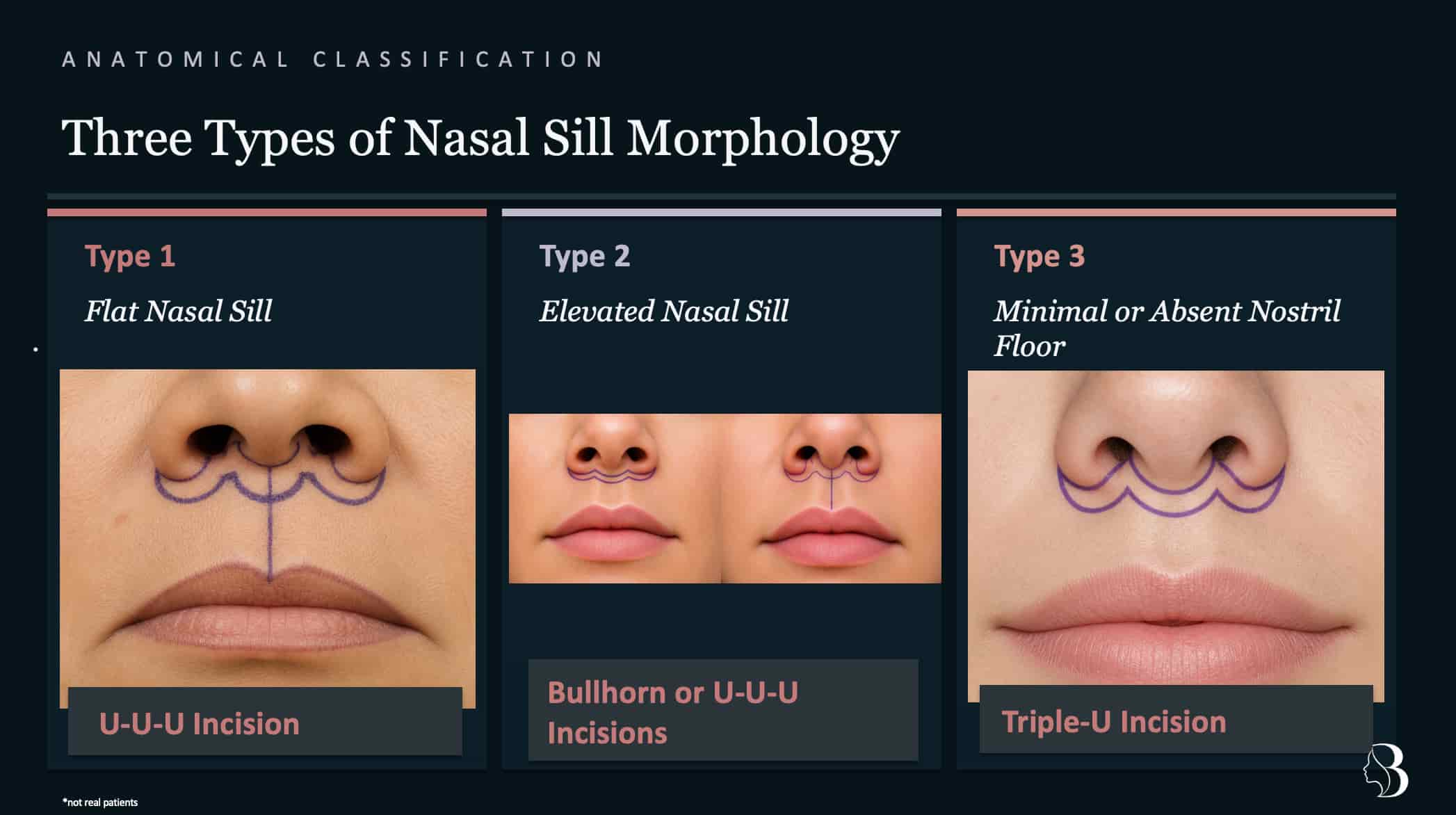 Dr. Rafizadeh&rsquo;s anatomical classification of nasal-sill morphology for lip lift planning. Type 1: Flat nasal sill &mdash; treated with a U-U-U incision. Type 2: Elevated nasal sill &mdash; treated with bullhorn or U-U-U incisions. Type 3: Minimal or absent nostril floor &mdash; treated with a Triple-U (sill-crossing) incision.