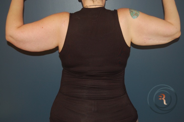 Before — Arm Lift