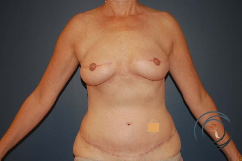 After — Breast Reconstruction