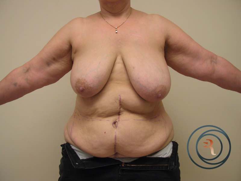 Before — Breast Reconstruction