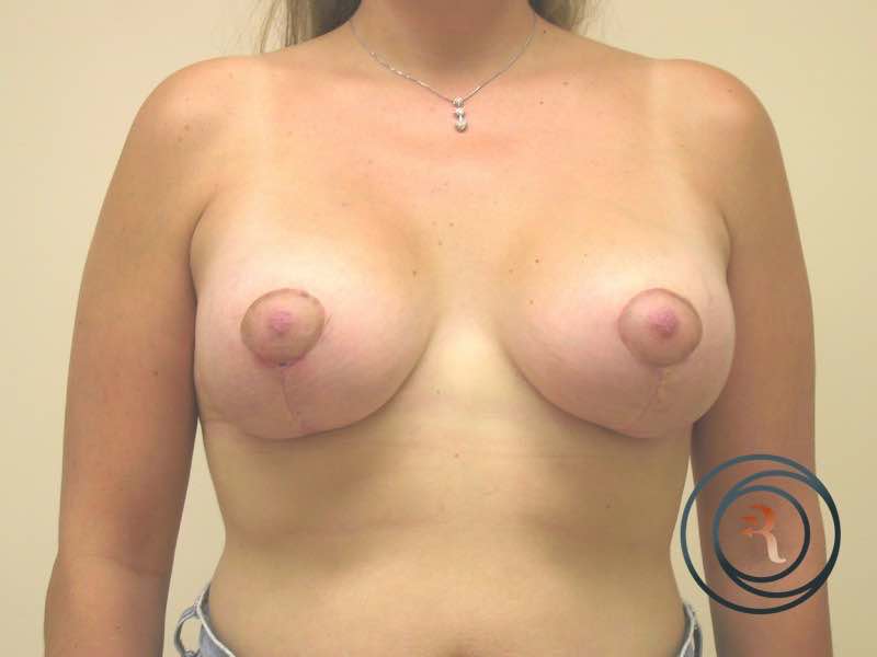 After — Breast Lift