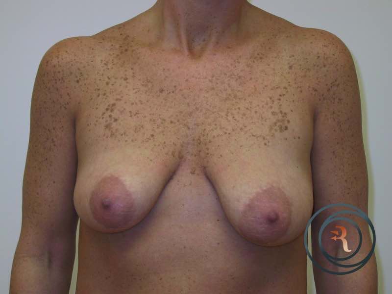 Before — Breast Augmentation with Lift