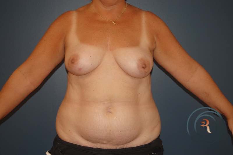 Before — Breast Reconstruction