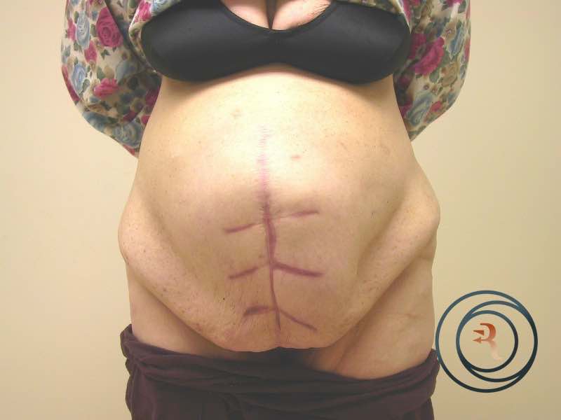 Before — Abdominoplasty