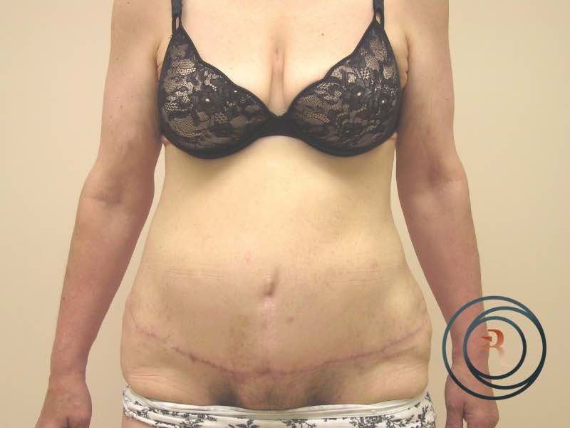After — Abdominoplasty