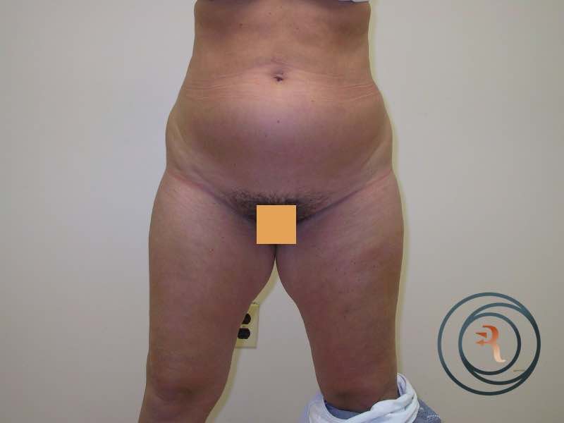 Before — Liposuction