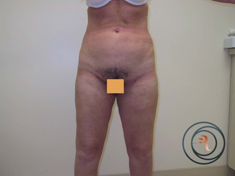 After — Liposuction