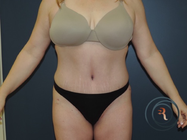 After — Abdominoplasty