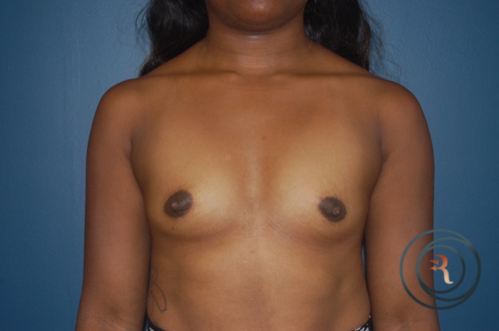 Before — Breast Augmentation