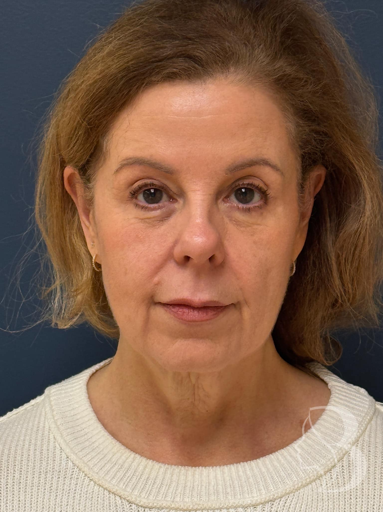 Deep plane facelift and fat transfer after &mdash; lifted, naturally full result