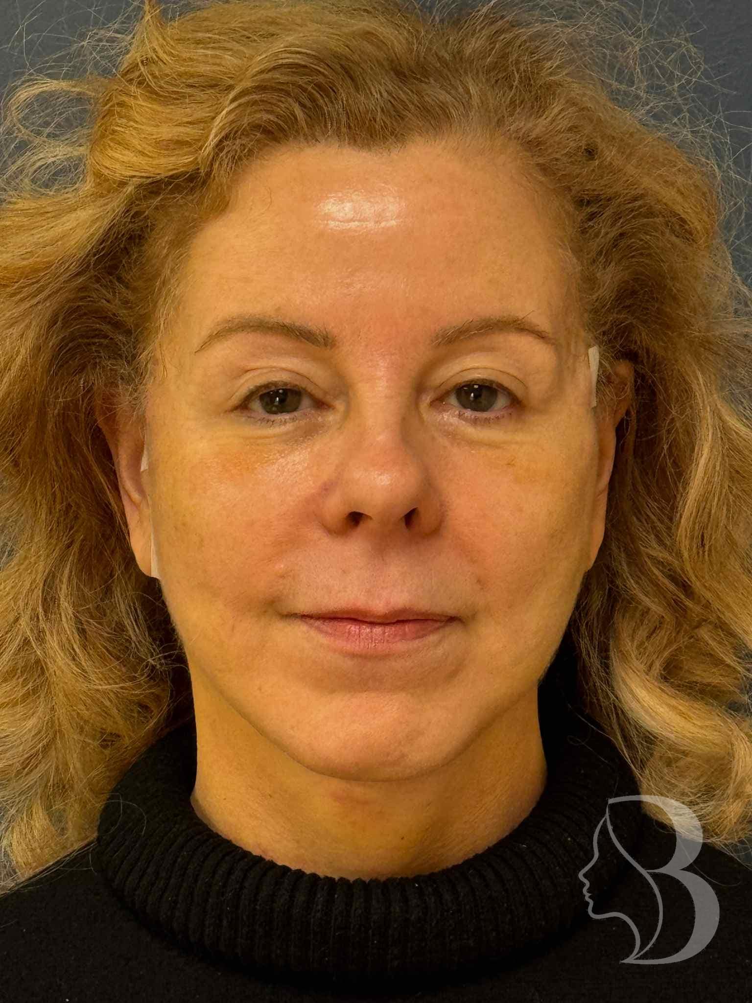 Deep plane facelift before &mdash; Morristown NJ patient showing jowling and volume loss