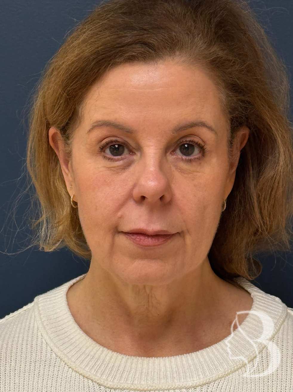 Deep plane facelift before