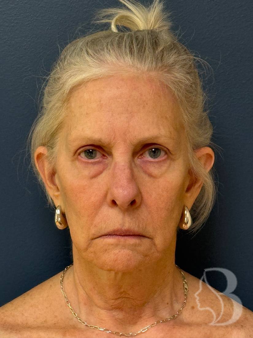 Deep plane face and neck lift before