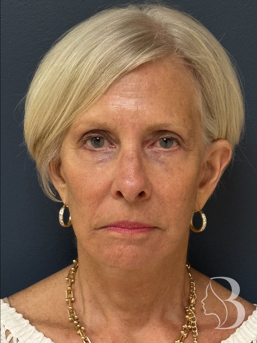 Deep plane face and neck lift after