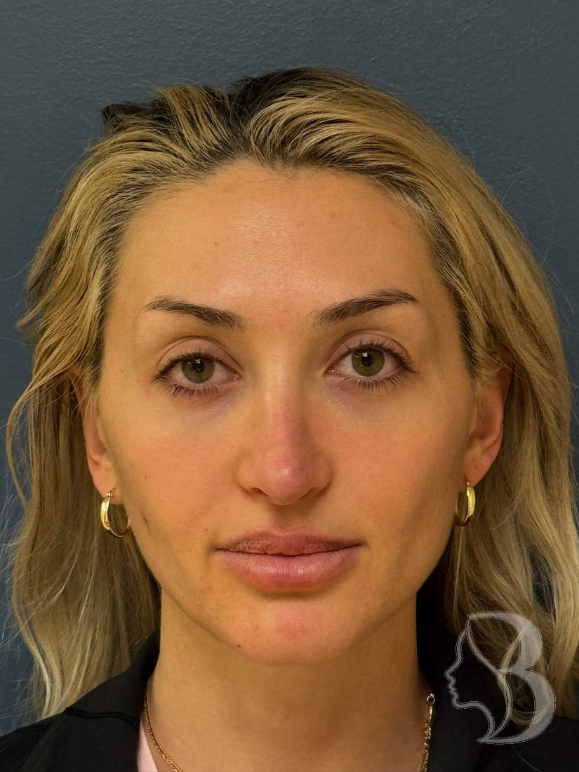 Open rhinoplasty before