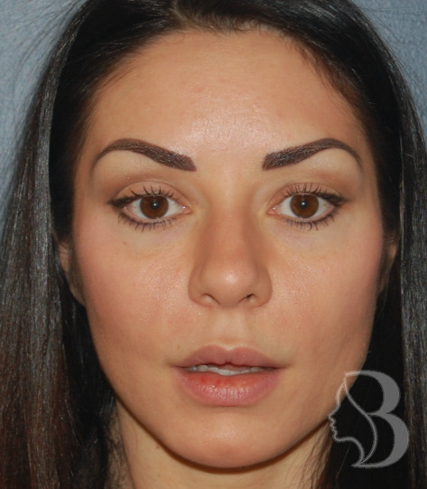Lip Lift before