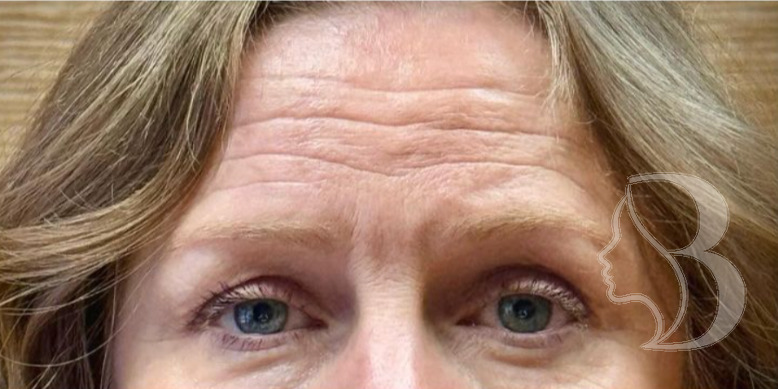 Dysport - Brow Lift before