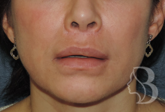 Revision Lip Lift before