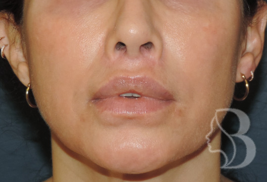 Revision Lip Lift after