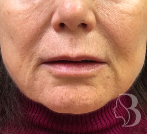 Lip Lift before