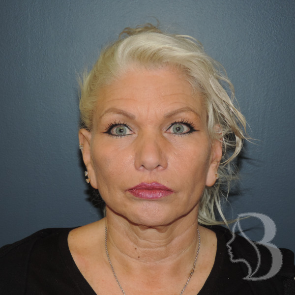 Face and neck lift with lower blepharoplasty before