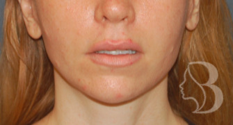 Lip Lift after