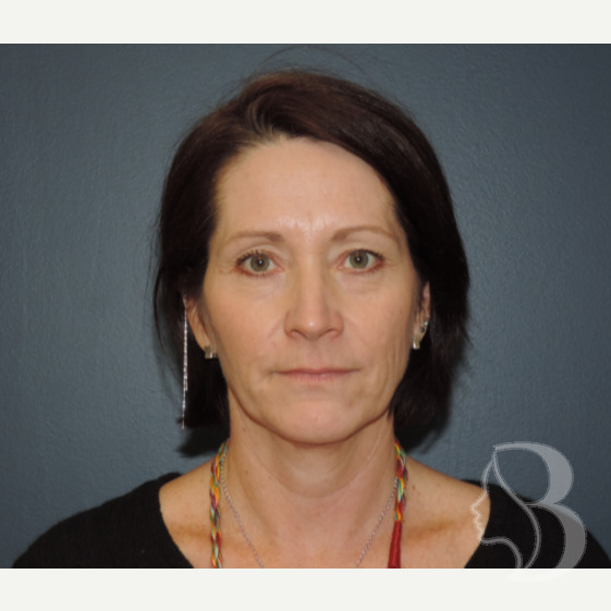 Face & Neck Lift, Upper & Lower Blepharoplasty before
