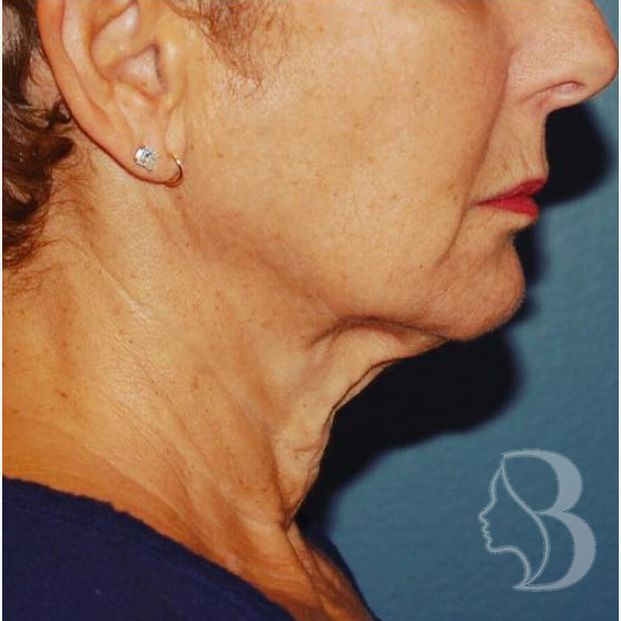 Lip Lift, Facelift, Neck Lift before