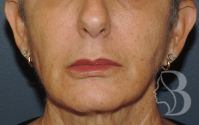 Lip lift before — long philtrum, Morristown NJ