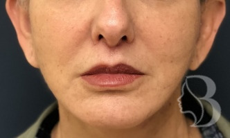 Lip lift after — permanent structural change vs filler