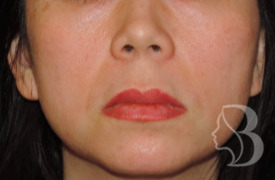 Lip Lift before