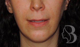 Lip lift before — diminished tooth show