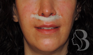 Lip lift after — elevated upper lip, Dr. Rafizadeh
