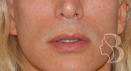 Lip Lift before