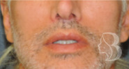 Lip Lift after