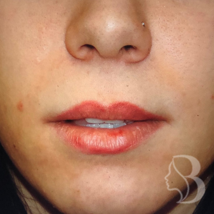 Lip Lift before