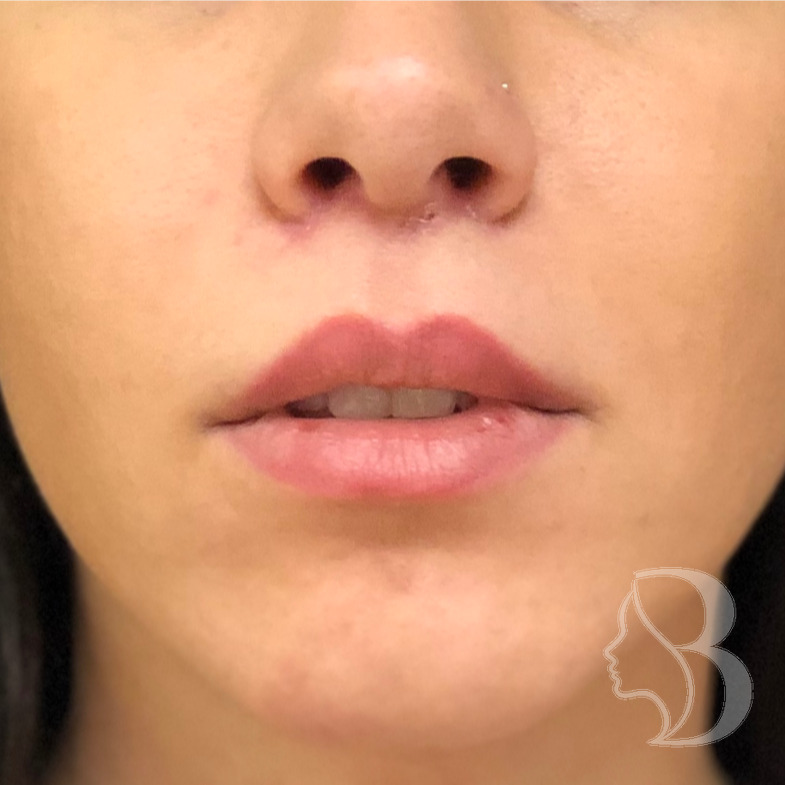 Lip Lift after