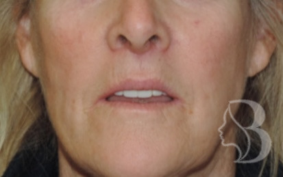 Lip Lift after