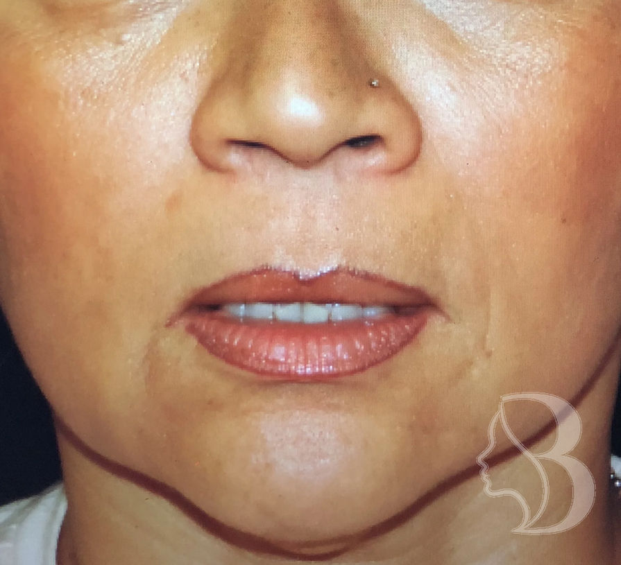Subnasal lip lift before — Morristown, NJ patient