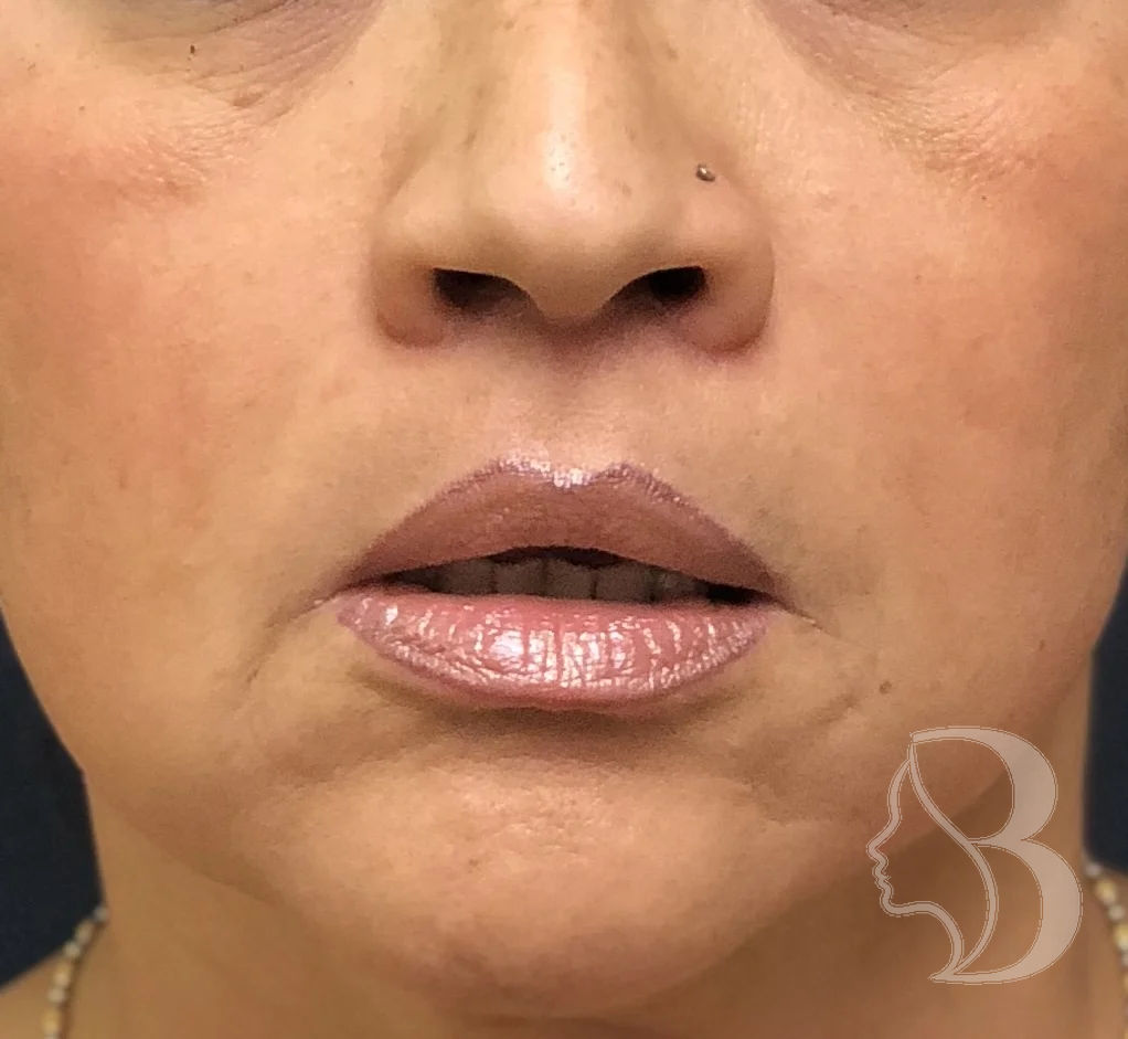Subnasal lip lift after — Dr. Rafizadeh, North Jersey & NYC