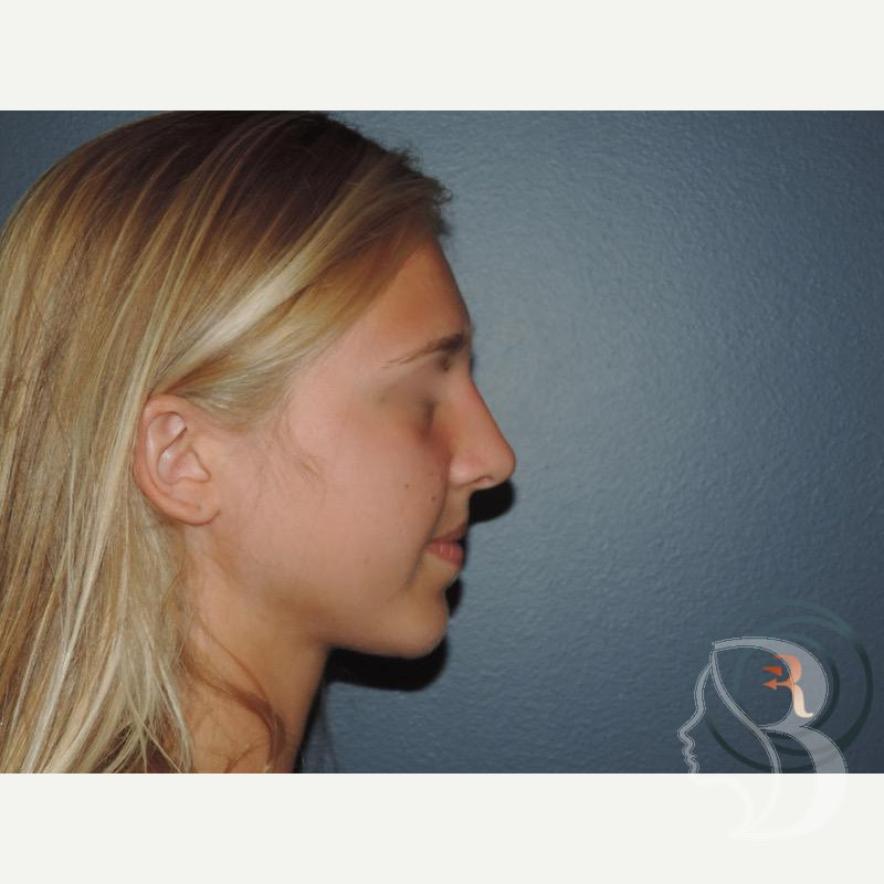 Rhinoplasty, Chin Implant after