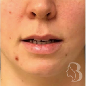 Lip lift before — younger patient