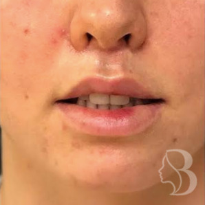 Lip lift after — refined upper lip