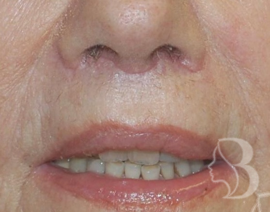 Lip Lift after