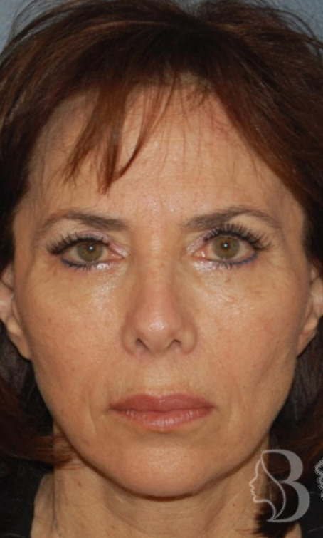 Lip Lift, Facelift, Brow Lift, Forehead Reduction, Revision Rhinoplasty before