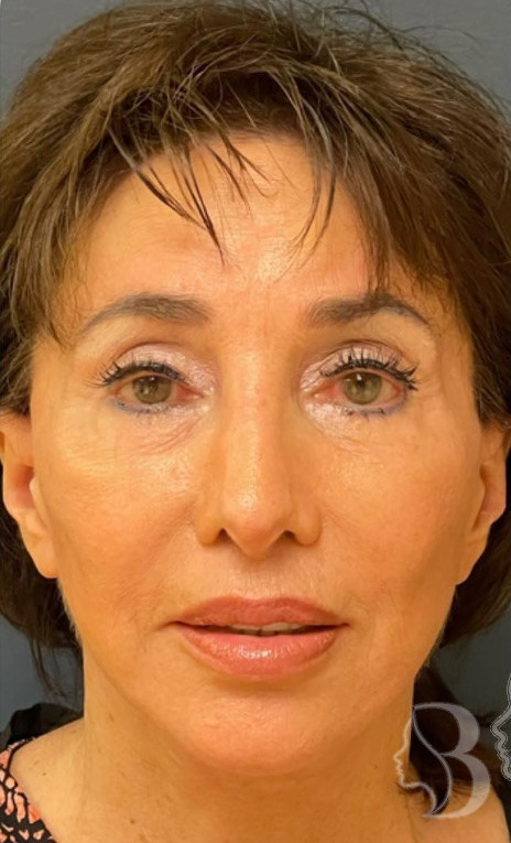 Lip Lift, Facelift, Brow Lift, Forehead Reduction, Revision Rhinoplasty after