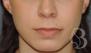 Lip Lift after