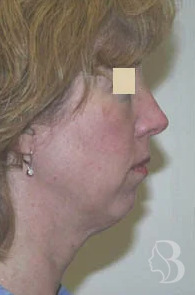 Chin Implant before