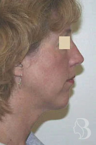 Chin Implant after