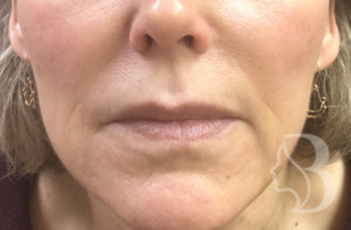 Lip Filler - Restylane Silk before
